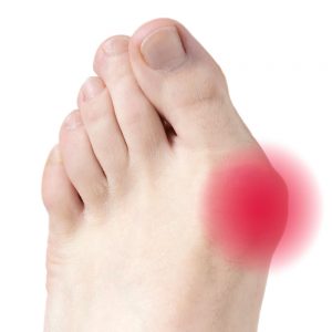 Разделител и предп. за палец Hallux valgus - снимка 2